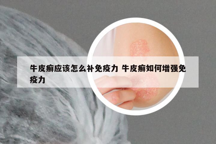 牛皮癣应该怎么补免疫力 牛皮癣如何增强免疫力