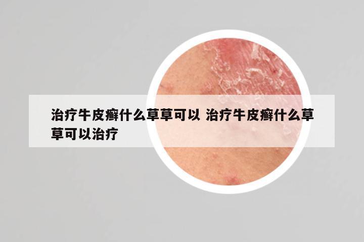 治疗牛皮癣什么草草可以 治疗牛皮癣什么草草可以治疗
