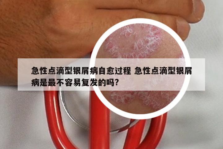 急性点滴型银屑病自愈过程 急性点滴型银屑病是最不容易复发的吗?