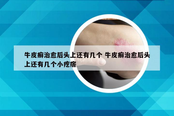 牛皮癣治愈后头上还有几个 牛皮癣治愈后头上还有几个小疙瘩