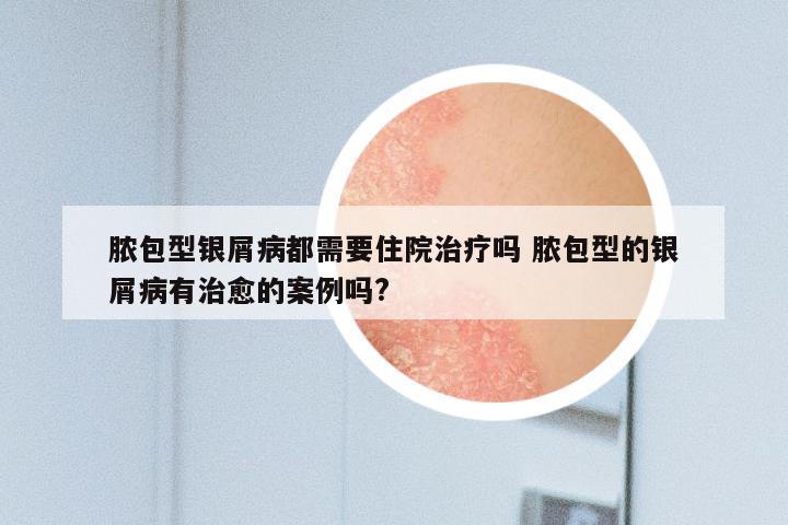 脓包型银屑病都需要住院治疗吗 脓包型的银屑病有治愈的案例吗?