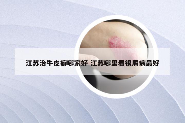 江苏治牛皮癣哪家好 江苏哪里看银屑病最好