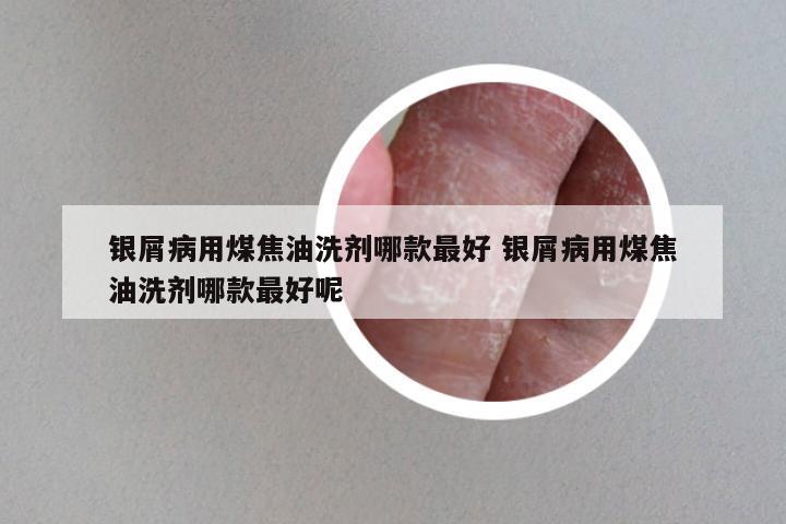 银屑病用煤焦油洗剂哪款最好 银屑病用煤焦油洗剂哪款最好呢