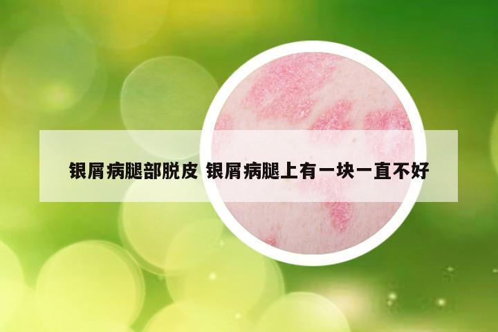 银屑病腿部脱皮 银屑病腿上有一块一直不好