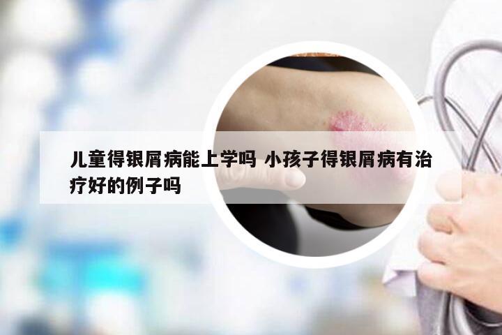 儿童得银屑病能上学吗 小孩子得银屑病有治疗好的例子吗