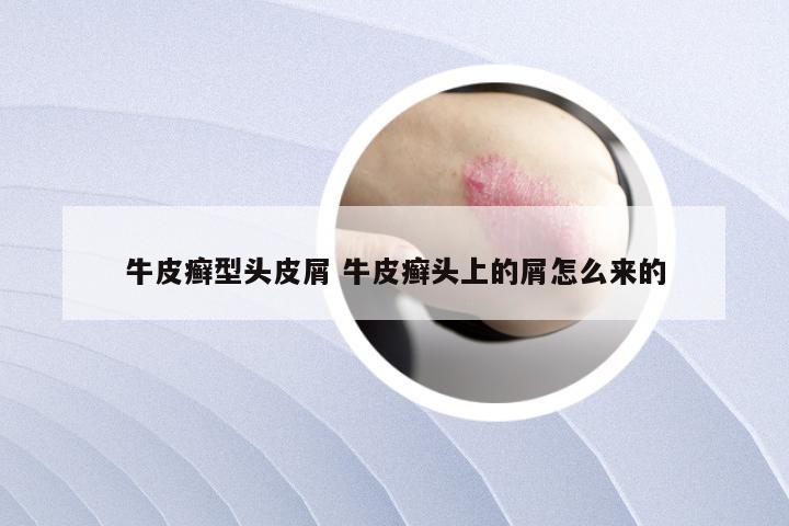 牛皮癣型头皮屑 牛皮癣头上的屑怎么来的