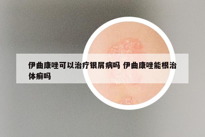 伊曲康唑可以治疗银屑病吗 伊曲康唑能根治体癣吗
