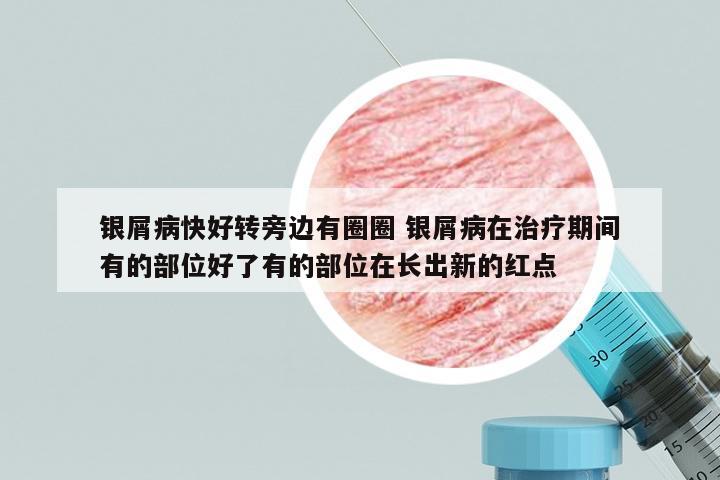 银屑病快好转旁边有圈圈 银屑病在治疗期间有的部位好了有的部位在长出新的红点