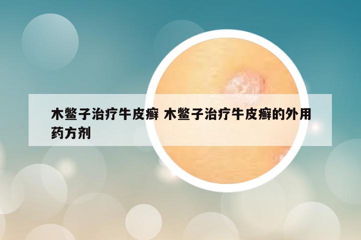 木鳖子治疗牛皮癣 木鳖子治疗牛皮癣的外用药方剂