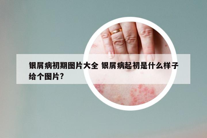 银屑病初期图片大全 银屑病起初是什么样子给个图片?