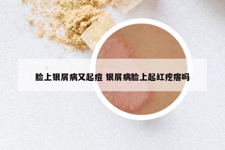 脸上银屑病又起痘 银屑病脸上起红疙瘩吗