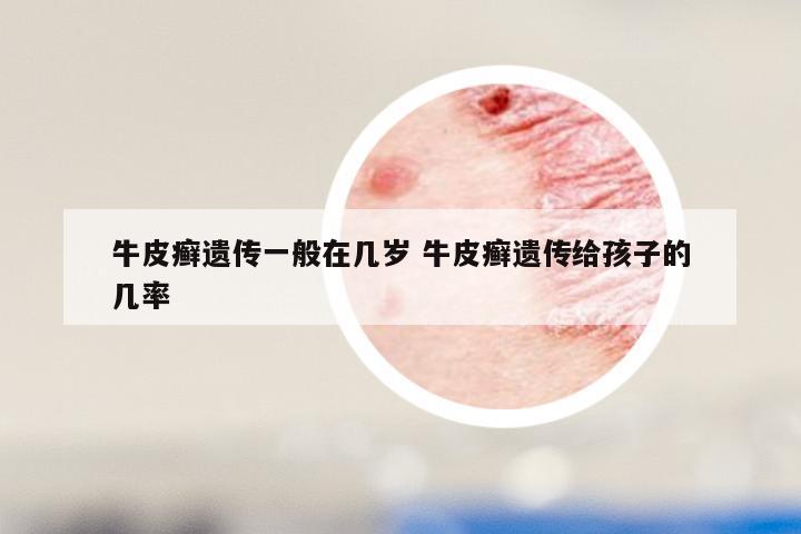 牛皮癣遗传一般在几岁 牛皮癣遗传给孩子的几率