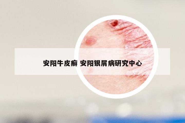 安阳牛皮癣 安阳银屑病研究中心