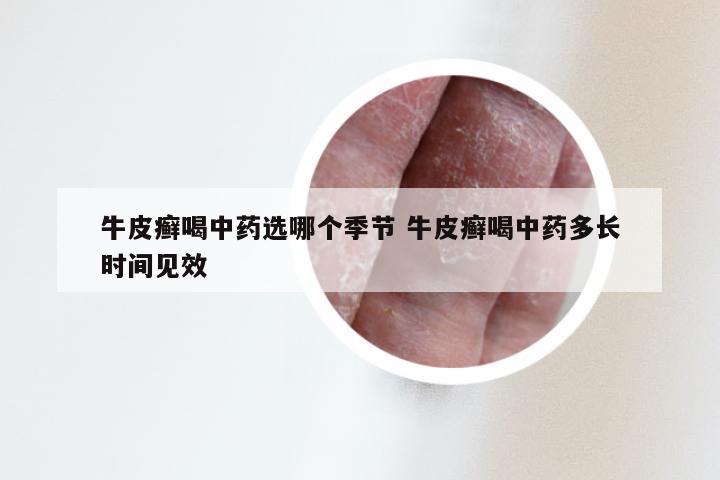 牛皮癣喝中药选哪个季节 牛皮癣喝中药多长时间见效