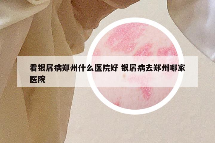 看银屑病郑州什么医院好 银屑病去郑州哪家医院