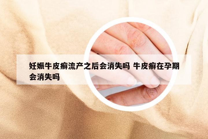 妊娠牛皮癣流产之后会消失吗 牛皮癣在孕期会消失吗