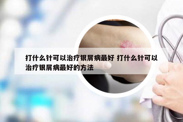 打什么针可以治疗银屑病最好 打什么针可以治疗银屑病最好的方法