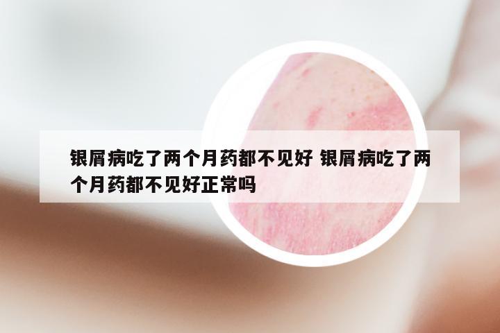 银屑病吃了两个月药都不见好 银屑病吃了两个月药都不见好正常吗