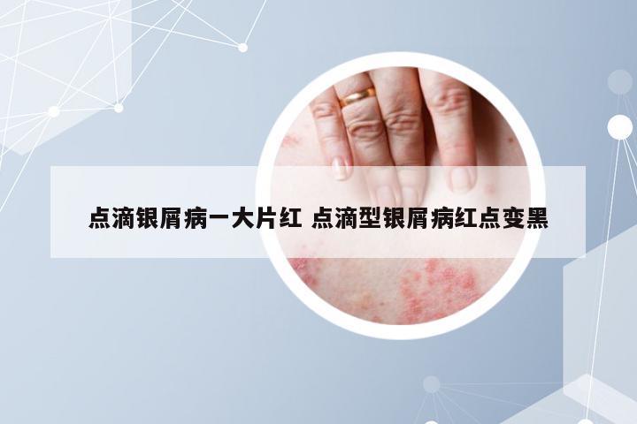 点滴银屑病一大片红 点滴型银屑病红点变黑