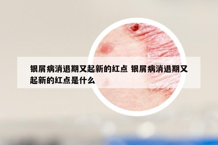 银屑病消退期又起新的红点 银屑病消退期又起新的红点是什么