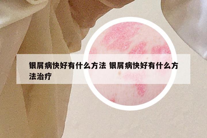 银屑病快好有什么方法 银屑病快好有什么方法治疗
