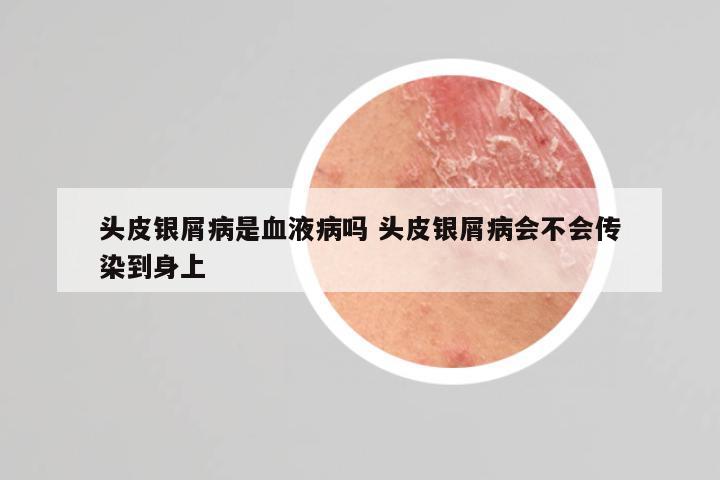 头皮银屑病是血液病吗 头皮银屑病会不会传染到身上