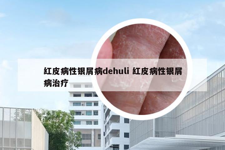 红皮病性银屑病dehuli 红皮病性银屑病治疗