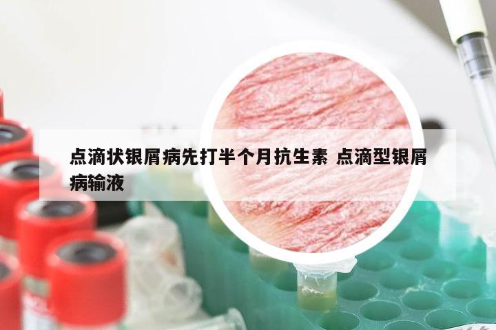 点滴状银屑病先打半个月抗生素 点滴型银屑病输液
