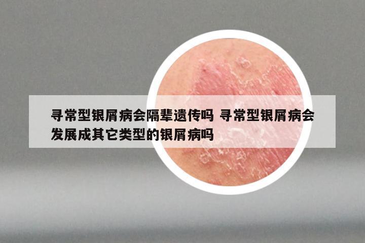寻常型银屑病会隔辈遗传吗 寻常型银屑病会发展成其它类型的银屑病吗