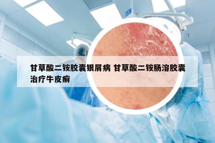 甘草酸二铵胶囊银屑病 甘草酸二铵肠溶胶囊治疗牛皮癣