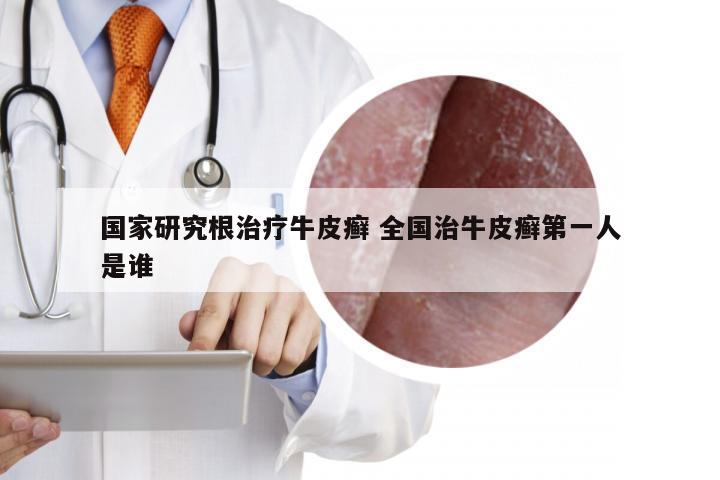 国家研究根治疗牛皮癣 全国治牛皮癣第一人是谁