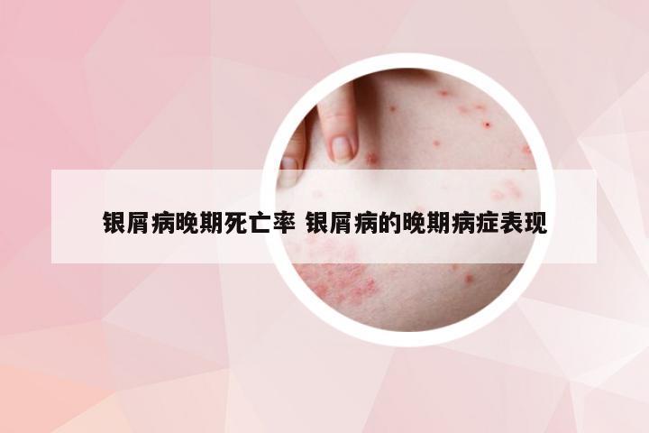 银屑病晚期死亡率 银屑病的晚期病症表现