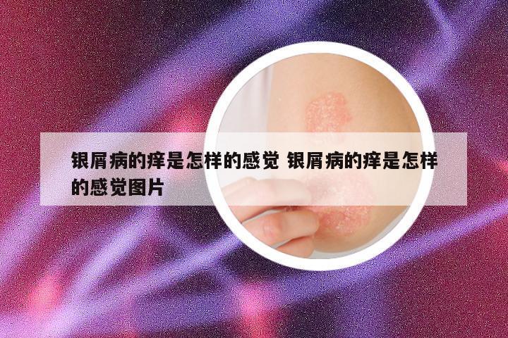 银屑病的痒是怎样的感觉 银屑病的痒是怎样的感觉图片