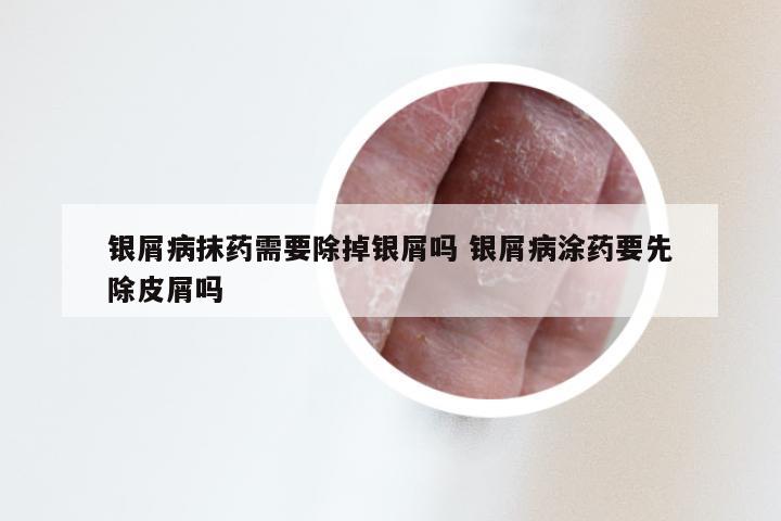 银屑病抹药需要除掉银屑吗 银屑病涂药要先除皮屑吗