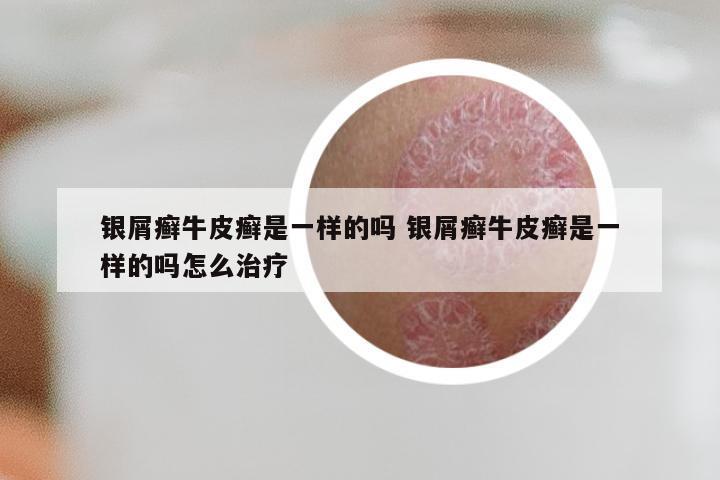 银屑癣牛皮癣是一样的吗 银屑癣牛皮癣是一样的吗怎么治疗