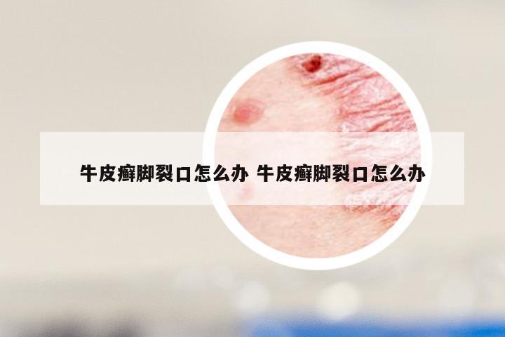 牛皮癣脚裂口怎么办 牛皮癣脚裂口怎么办