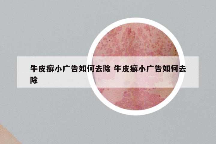 牛皮癣小广告如何去除 牛皮癣小广告如何去除