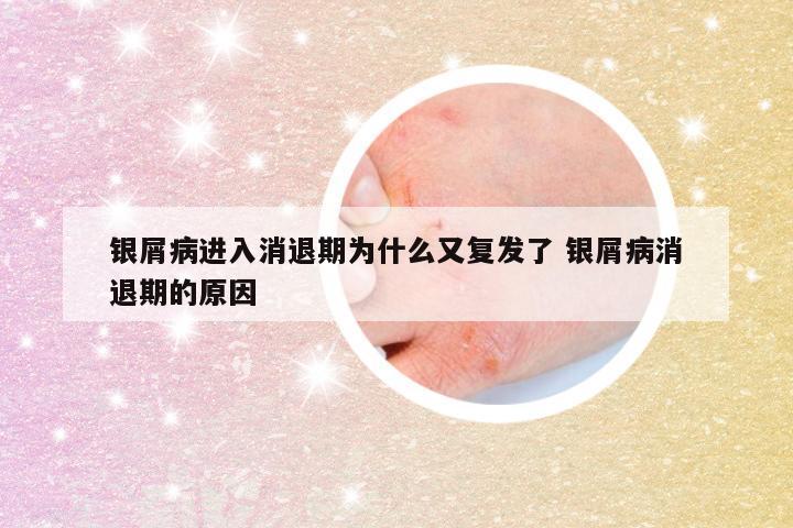 银屑病进入消退期为什么又复发了 银屑病消退期的原因