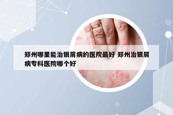 郑州哪里能治银屑病的医院最好 郑州治银屑病专科医院哪个好