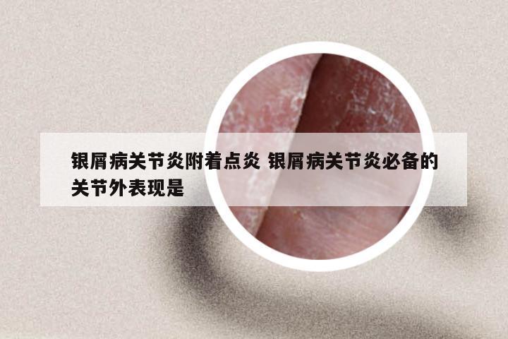银屑病关节炎附着点炎 银屑病关节炎必备的关节外表现是