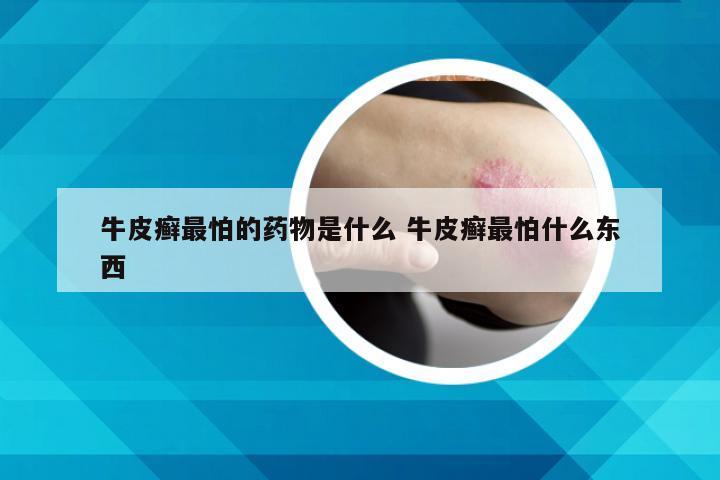 牛皮癣最怕的药物是什么 牛皮癣最怕什么东西