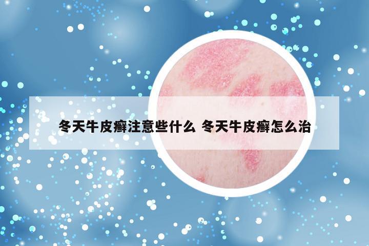 冬天牛皮癣注意些什么 冬天牛皮癣怎么治