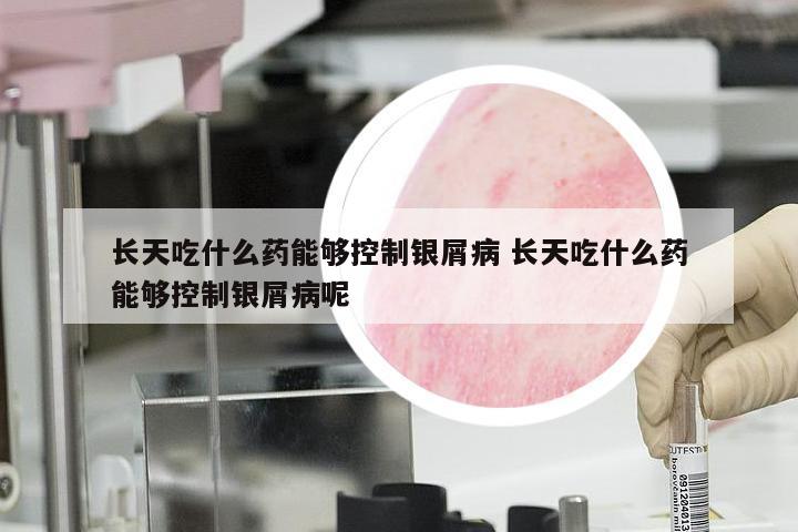 长天吃什么药能够控制银屑病 长天吃什么药能够控制银屑病呢