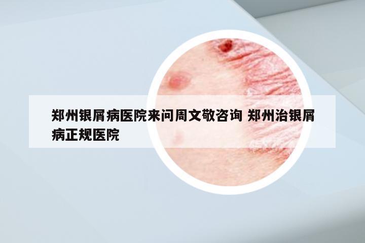 郑州银屑病医院来问周文敬咨询 郑州治银屑病正规医院
