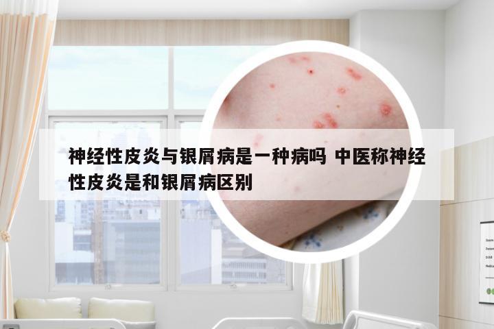 神经性皮炎与银屑病是一种病吗 中医称神经性皮炎是和银屑病区别