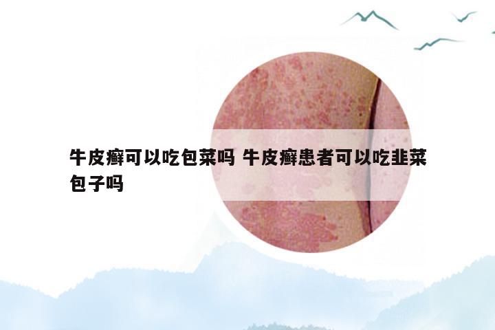 牛皮癣可以吃包菜吗 牛皮癣患者可以吃韭菜包子吗