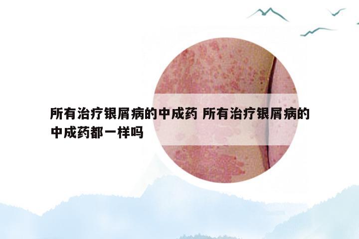 所有治疗银屑病的中成药 所有治疗银屑病的中成药都一样吗