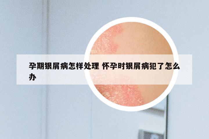 孕期银屑病怎样处理 怀孕时银屑病犯了怎么办