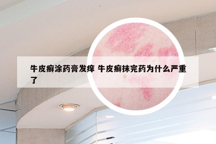 牛皮癣涂药膏发痒 牛皮癣抹完药为什么严重了
