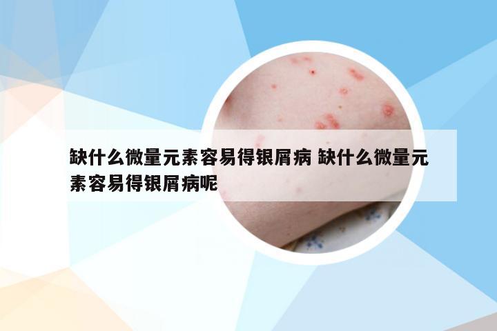 缺什么微量元素容易得银屑病 缺什么微量元素容易得银屑病呢